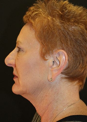 Face Lift Patient 18 - After 