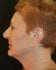 Face Lift Patient 18 - After Thumbnail 