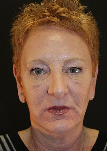 Face Lift Patient 18 - After 