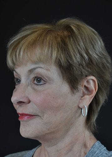 Face Lift Patient 19 - After 