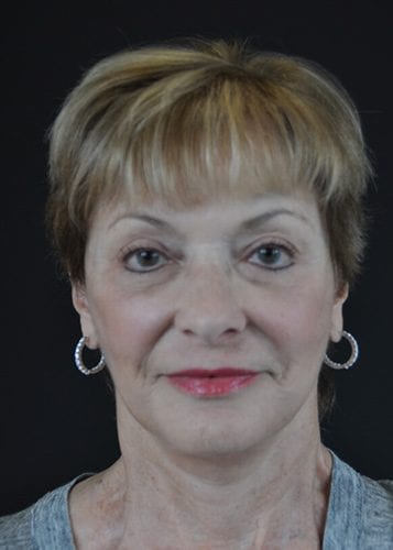 Face Lift Patient 19 - After 