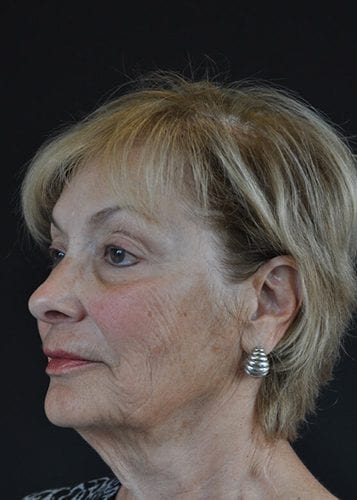 Face Lift Patient 19 - Before 