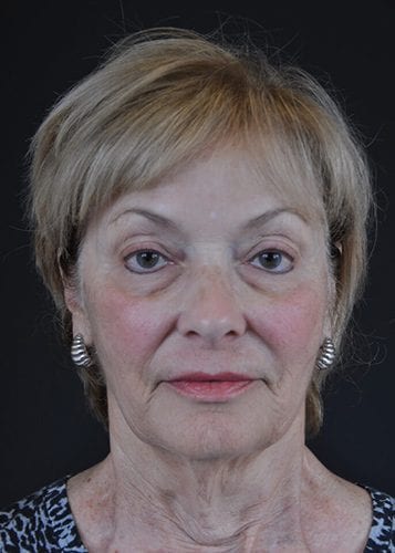 Face Lift Patient 19 - Before 