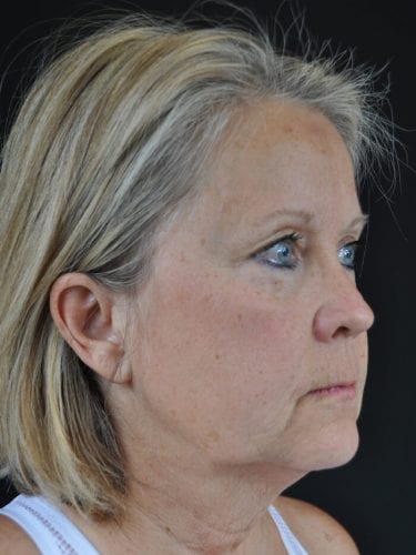 Face Lift Patient 20 - Before 