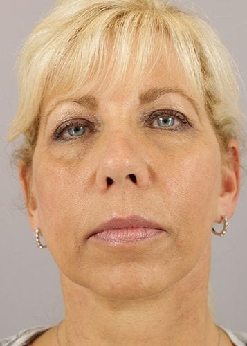Face Lift Patient 21 - After 