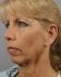 Face Lift Patient 21 - Before Thumbnail 