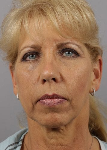 Face Lift Patient 21 - Before 