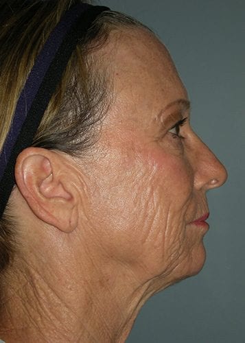 Face Lift Patient 22 - Before 