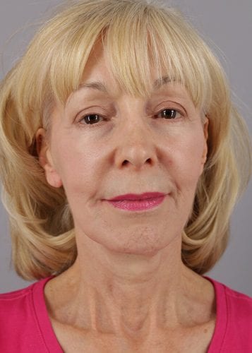 Face Lift Patient 23 - After 