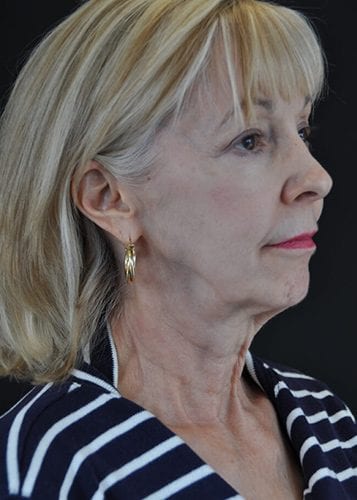 Face Lift Patient 23 - Before 