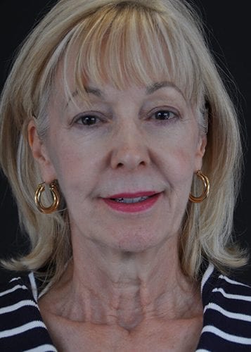 Face Lift Patient 23 - Before 