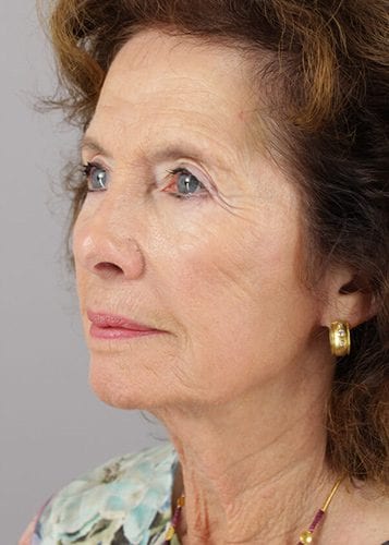 Face Lift Patient 24 - Before 