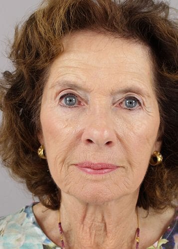 Face Lift Patient 24 - Before 