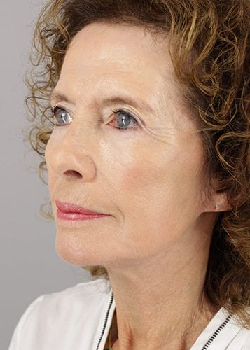 Face Lift Patient 24 - After 