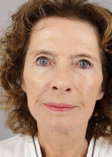 Face Lift Patient 24 - After 