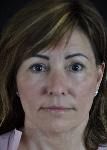 Face Lift Patient 25 - After 