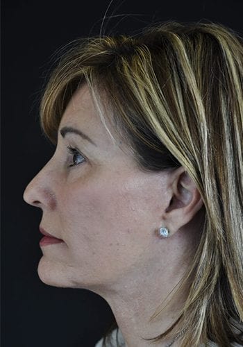 Face Lift Patient 25 - After 