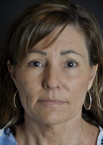 Face Lift Patient 25 - Before 