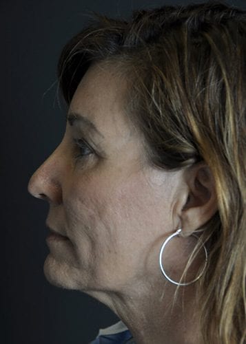 Face Lift Patient 25 - Before 