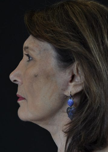 Face Lift Patient 26 - After 