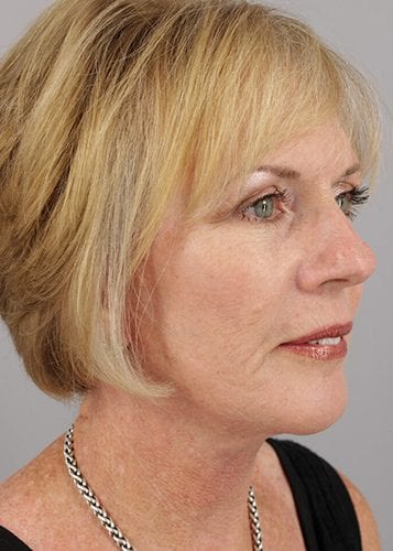 Face Lift Patient 27 - After 