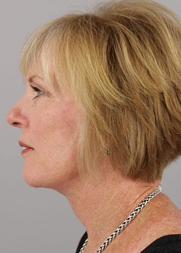 Face Lift Patient 27 - After 