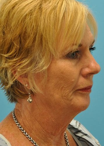 Face Lift Patient 27 - Before 