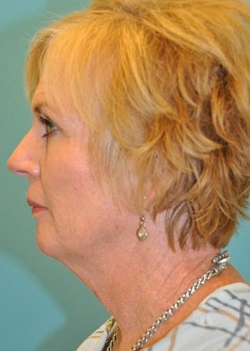 Face Lift Patient 27 - Before 