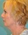Face Lift Patient 27 - Before Thumbnail 