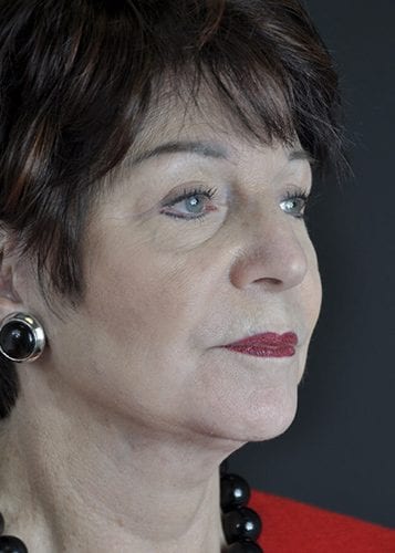 Face Lift Patient 28 - After 