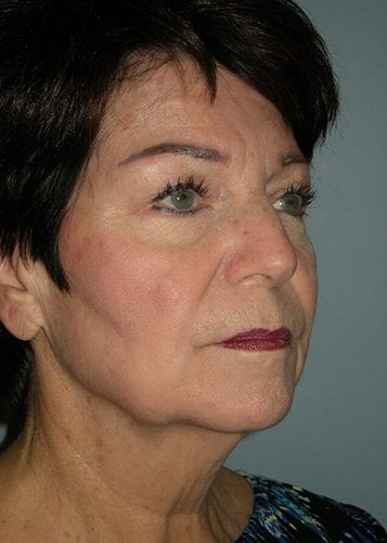 Face Lift Patient 28 - Before 