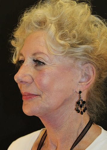 Face Lift Patient 29 - After 