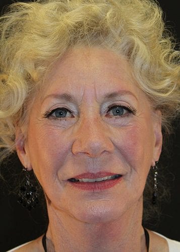 Face Lift Patient 29 - After 