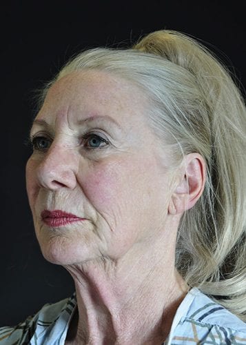 Face Lift Patient 29 - Before 