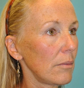 Brow Lift Patient 08 - After 