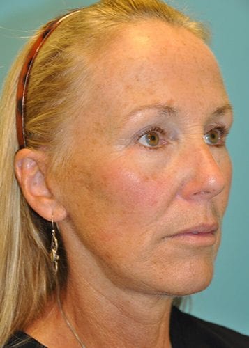 Face Lift Patient 30 - After 