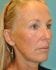 Face Lift Patient 30 - After Thumbnail 