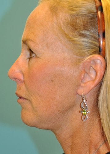 Face Lift Patient 30 - After 