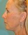 Face Lift Patient 30 - After Thumbnail 