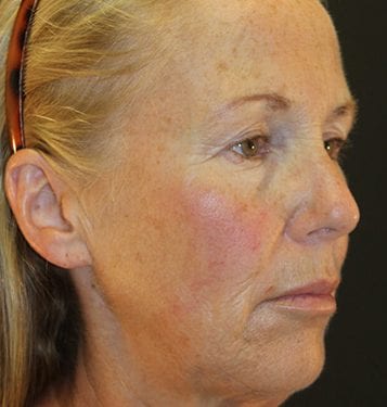 Brow Lift Patient 08 - Before 