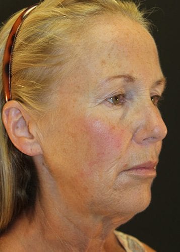 Face Lift Patient 30 - Before 