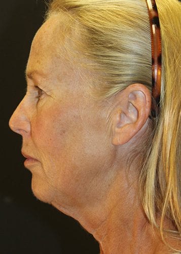 Face Lift Patient 30 - Before 