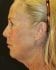 Face Lift Patient 30 - Before Thumbnail 