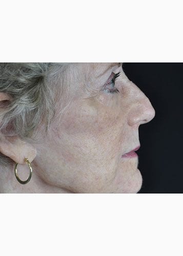 Face Lift Patient 31 - After 