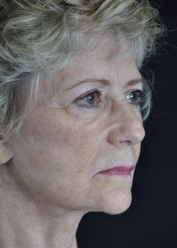 Face Lift Patient 31 - After 