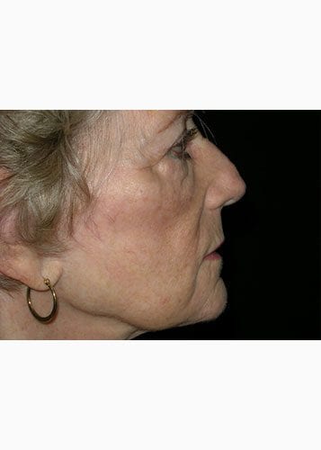 Face Lift Patient 31 - Before 