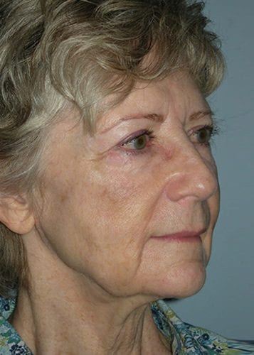 Face Lift Patient 31 - Before 