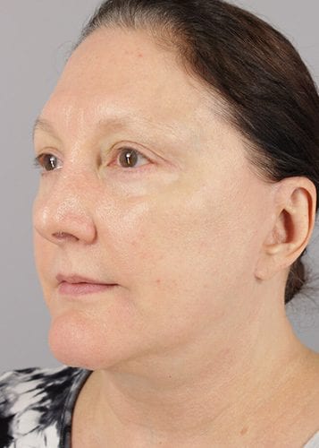 Face Lift Patient 32 - After 