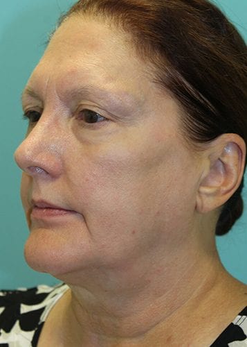 Face Lift Patient 32 - Before 