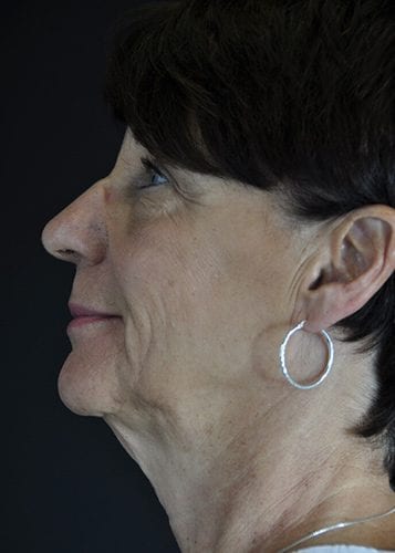 Face Lift Patient 33 - Before 